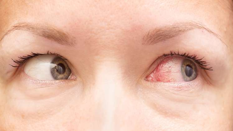 Eye allergies What are the causes of eye allergies and the best way to remove it 1