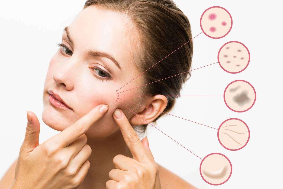 7 Home Remedies for Acne