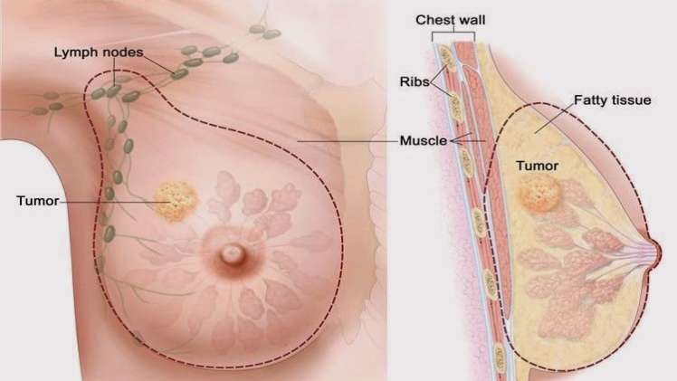 Mastectomy in the United Arab Emirates