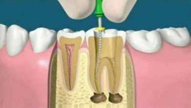 What is root canal treatment How expensive is it
