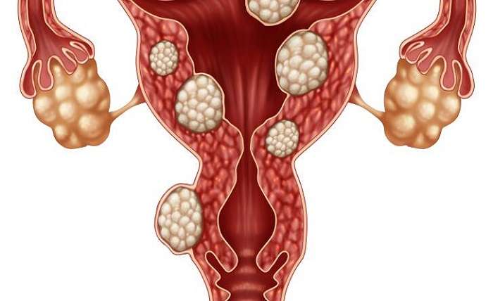 The Important Things to Know About Fibroids