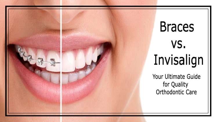How Much Does Invisible Braces Treatment Cost