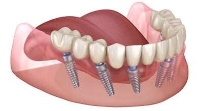 Complete Guide to Dental Implants in Los Angeles