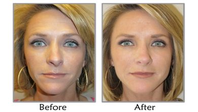 What is non surgical facelift treatment