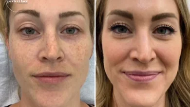 Client6 Zoe Skincare microneedling Before After nogreen copy 480x480