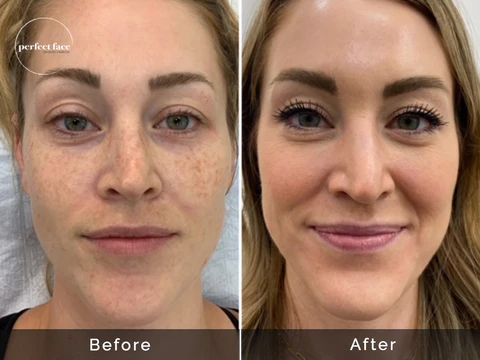 Client6 Zoe Skincare microneedling Before After